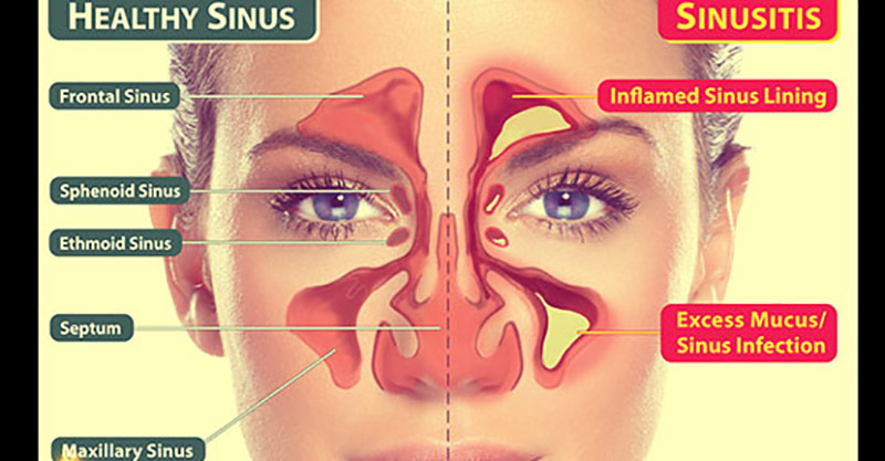 Different Types Of Sinus Infections Plus 9 Natural Cures Healthy Food 