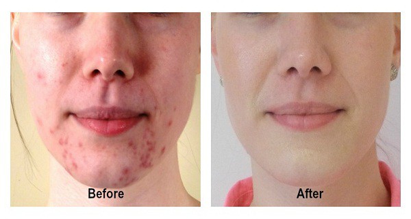 make-acne-and-pimples-disappear-forever-in-14-days