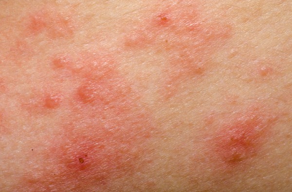 eczema atopic dermatitis symptom skin texture