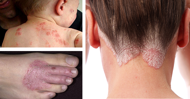 12 Natural Remedies For Eczema Rashes And A Range Of Persistent Skin