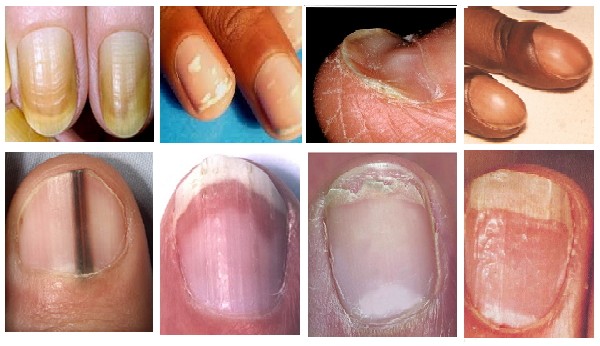 What Fingernail Abnormalities Say About Your Health 